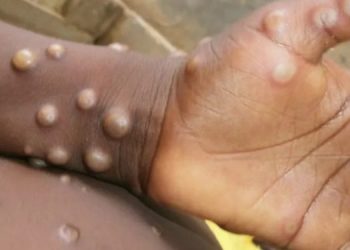 SESAP emite notas de alerta sobre varíola dos macacos