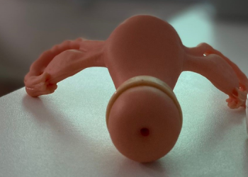 Com alta procura, Faculdade de Enfermagem e Hospital da Mulher realizam mutirão de colocação de DIU