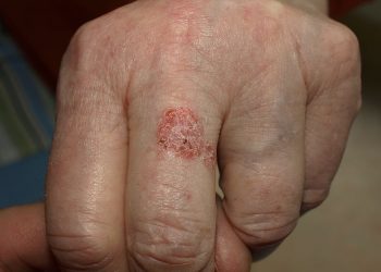 Mossoró recebe ação social da Campanha “Dezembro Laranja”