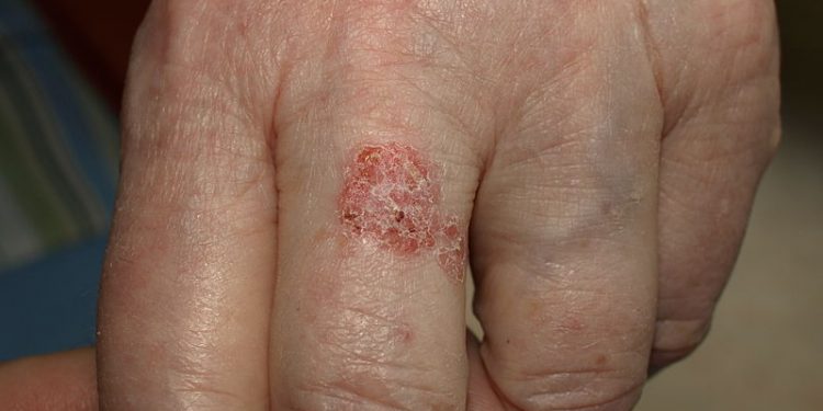 Mossoró recebe ação social da Campanha “Dezembro Laranja”