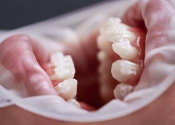 Anormalidade nos dentes, se diagnosticada de maneira precoce, pode trazer qualidade de vida para o ser humano.