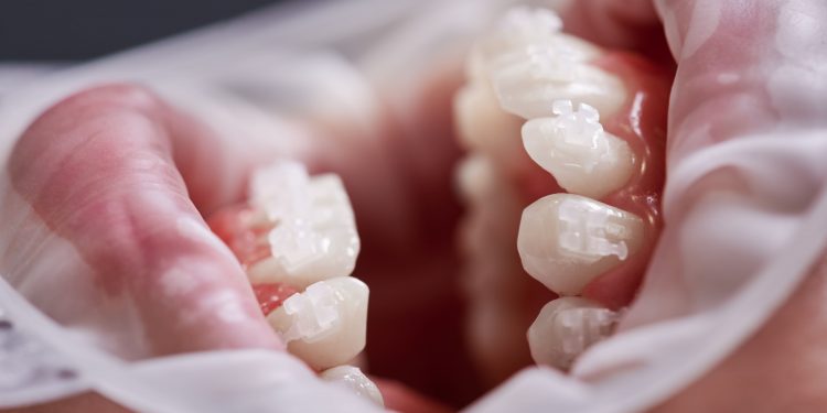 Anormalidade nos dentes, se diagnosticada de maneira precoce, pode trazer qualidade de vida para o ser humano.