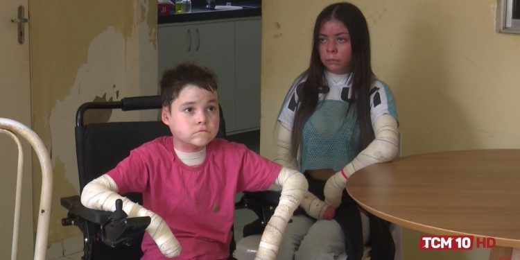 Irmãos com epidermólise bolhosa necessitam de doações