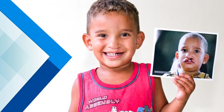 Tem início cadastro para pessoas com fissura labiopalatina poderem realizar a cirurgia gratuitamente